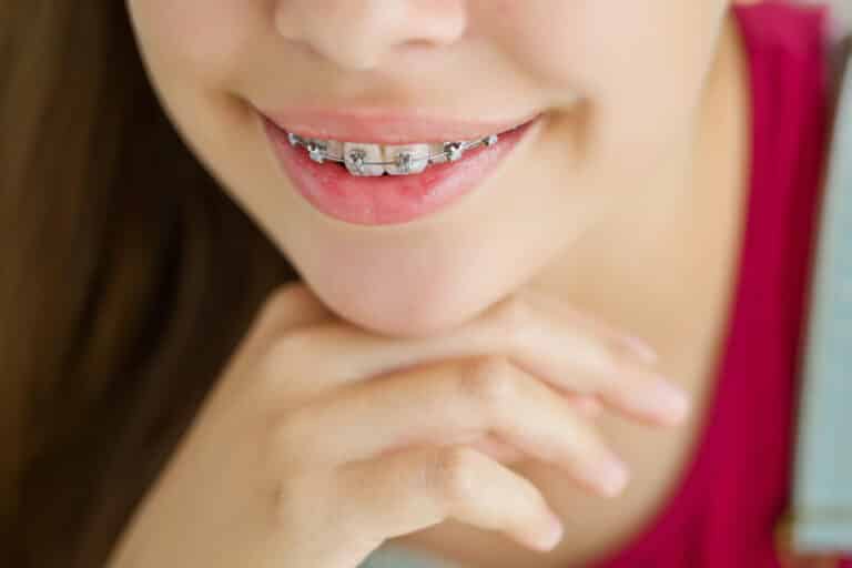 Close-up of a person smiling with metal braces, a reminder to enquire before starting orthodontic treatment.